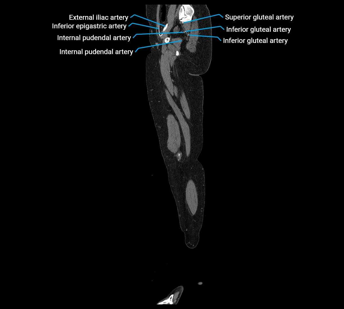 CTA lower limb sagittal cross sectional anatomy labelled image _20 (3).webp